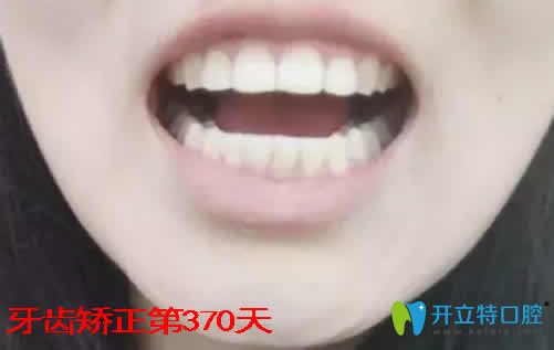 我在湛江致美口腔做牙齿矫正一年效果 我在湛江致美口腔做牙齿矫正一年效果