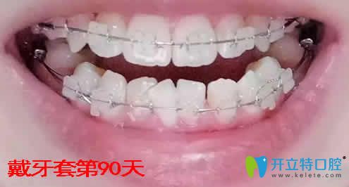 我在湛江致美口腔做牙齿矫正第90天照片 我在湛江致美口腔做牙齿矫正第90天照片