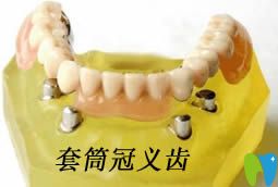详解什么是套筒冠义齿,以及套筒冠假牙的优缺点和制作过程