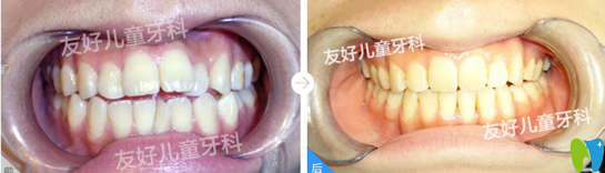 属于郑州友好儿童牙科前牙开合矫正案例前后效果对比图