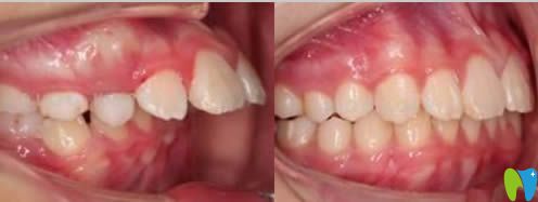 厦门亚欧齿科中心姚森牙齿正畸案例图