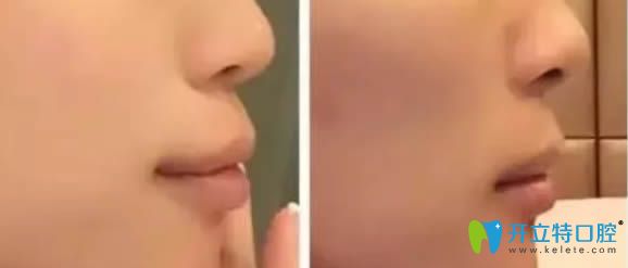 广州壹加壹口腔龅牙矫正案例效果图