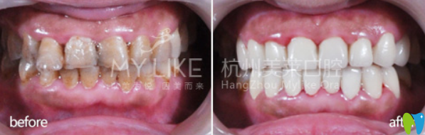 杭州美莱口腔明星全瓷牙修复牙齿案例前后效果对比