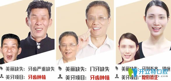 全口种植牙及门牙缺失种植案例效果图 全口种植牙及门牙缺失种植案例效果图