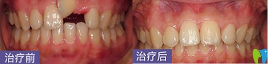深圳烤瓷牙哪家好?鹏程口腔牙齿修复案例来喽 深圳烤瓷牙哪家好?鹏程口腔牙齿修复案例来喽