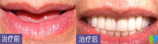 深圳哪家种植牙好?看深圳鹏程口腔种植牙案例 深圳哪家种植牙好?看深圳鹏程口腔种植牙案例
