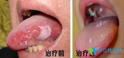 口腔黏膜白斑治疗前后效果对比