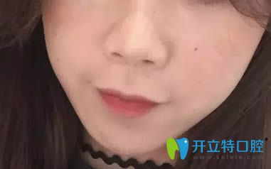 摘掉牙套后拔四颗牙的脸型变化图