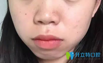 在厦门<!--<i data=20240703-sp></i>-->口腔刚戴牙套的照片