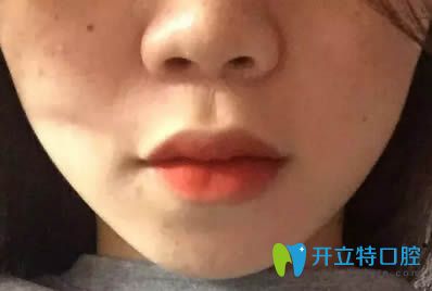  快收完缝隙阶段的矫正效果