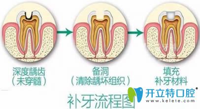 开立特口腔网儿童补牙有必要吗