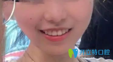 在深圳乐莎莎口腔做完不拔牙矫正18个月后正畸效果