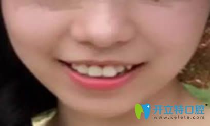 佩戴正雅隐形牙套3个月留照