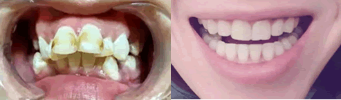 我在拉斐尔口腔做牙齿矫正1-12月对比图