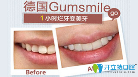 属于福州格莱美德国Gumsmile修复牙齿案例前后独对比照片