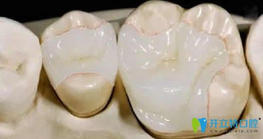 武汉优益佳口腔李明医生介绍牙齿嵌体的优势