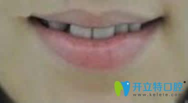 我在深圳和美口腔做牙齿矫正第3个月照片