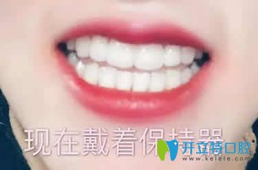 我在深圳和美口腔做牙齿矫正戴保持器的照片