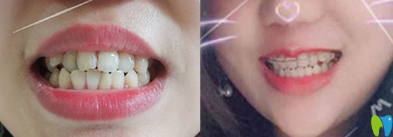 在北京溪美康口腔做牙齿矫正后对比 在北京溪美康口腔做牙齿矫正后对比