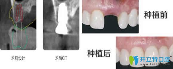 重庆华诺世口腔种植牙前后对比图