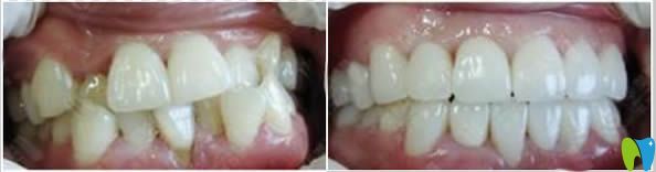 牙齿中度畸形矫正案例对比效果图