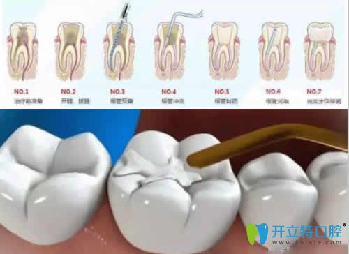武汉优益佳口腔潘斌医生介绍根管治疗步骤