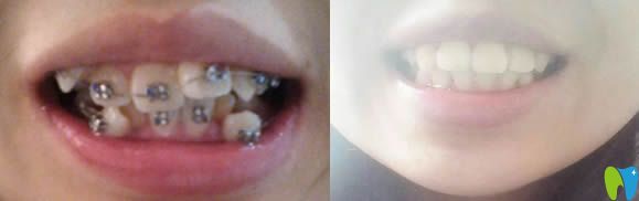 在泉兴口腔拔了4颗牙矫正后的牙齿对比图