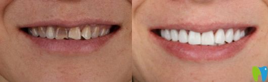 李以霄好莱坞白改善四环素牙的贴面修复案例治疗前后对比
