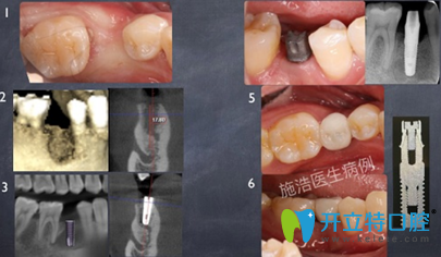 施浩3M镭射美容冠修复牙齿案例