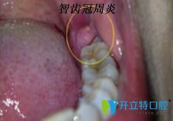 急性智齿冠周炎图 急性智齿冠周炎图