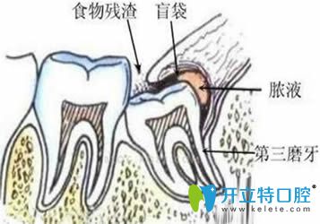 引起智齿冠周炎的原因是什么 引起智齿冠周炎的原因是什么