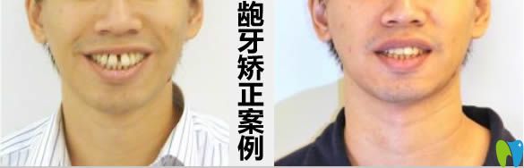 龅牙矫正案例及前后对比效果