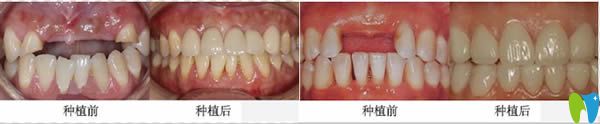 贵阳华美口腔半口牙缺失种植案例对比图
