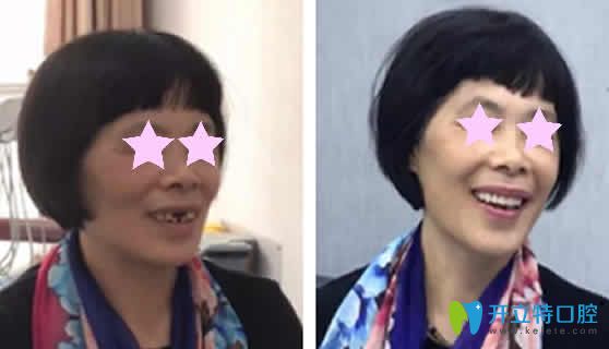 老妈在重庆华诺世口腔做种植牙前后对比照片