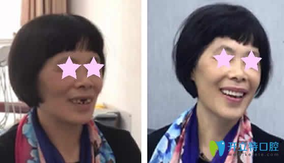 老妈在重庆华诺世口腔做种植牙前后对比照片 老妈在重庆华诺世口腔做种植牙前后对比照片