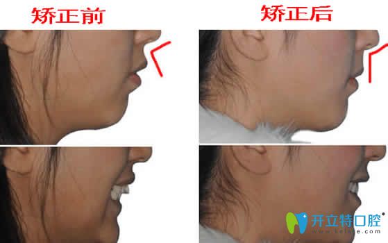 成都德顿齿科隐形牙齿矫正前后对比图 成都德顿齿科隐形牙齿矫正前后对比图