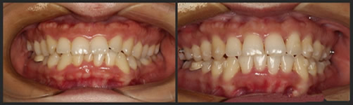 8种牙齿正畸动态图解析牙齿矫正全过程(gif图片)