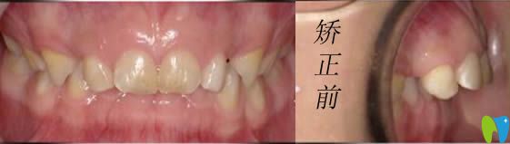 小孩在<!--<i data=20240703-sp></i>-->恒愿齿科做牙齿矫正前的照片