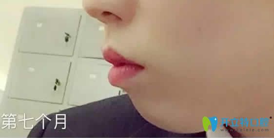 我在成都德顿齿科做牙齿矫正第7个月照片 我在成都德顿齿科做牙齿矫正第7个月照片