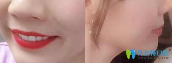 我在成都德顿齿科做牙齿矫正2年效果 我在成都德顿齿科做牙齿矫正2年效果