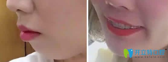 我在成都德顿齿科做陶瓷托槽矫正第15个月照片 我在成都德顿齿科做陶瓷托槽矫正第15个月照片