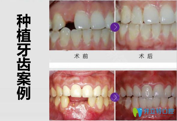 广州壹加壹口腔郑育亮医生多颗牙缺失种植案例 广州壹加壹口腔郑育亮医生多颗牙缺失种植案例
