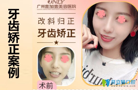 广州壹加壹口腔苏文新牙齿矫正案例图 广州壹加壹口腔苏文新牙齿矫正案例图