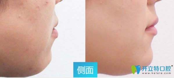 深覆盖牙齿矫正案例及矫正后脸型变化 深覆盖牙齿矫正案例及矫正后脸型变化