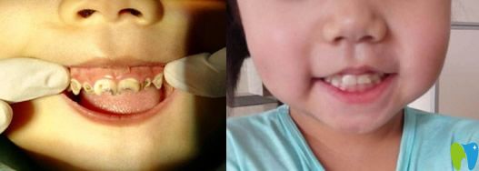 西安惟真口腔儿童牙齿龋坏修复案例