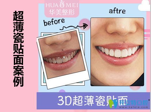 汕头华美口腔<!--<i data=20240703-sp></i>-->超薄瓷贴面修复前后对比效果