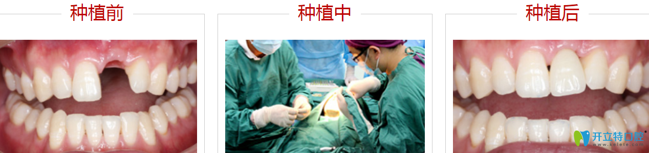 深圳哪里种牙比较好?来看格伦菲尔种植牙案例 深圳哪里种牙比较好?来看格伦菲尔种植牙案例