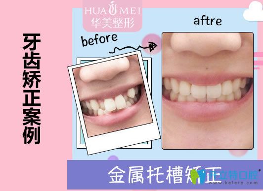汕头华美口腔王宏伟医生虎牙矫正案例及对比效果 汕头华美口腔王宏伟医生虎牙矫正案例及对比效果