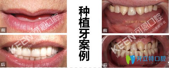上海可恩口腔全口及半口种植牙案例