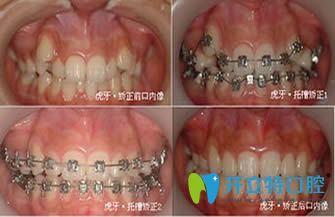 唇侧矫正案例效果图 唇侧矫正案例效果图